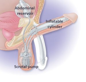 Penile Prosthetic Surgery Penile Implant In Sydney Katelaris Urology