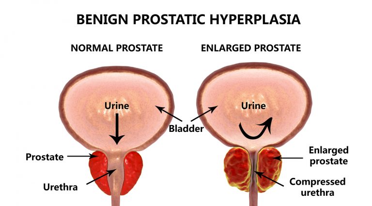 Enlarged Prostate Bph Symptoms Diagnosis And Treatment Sydney 0300