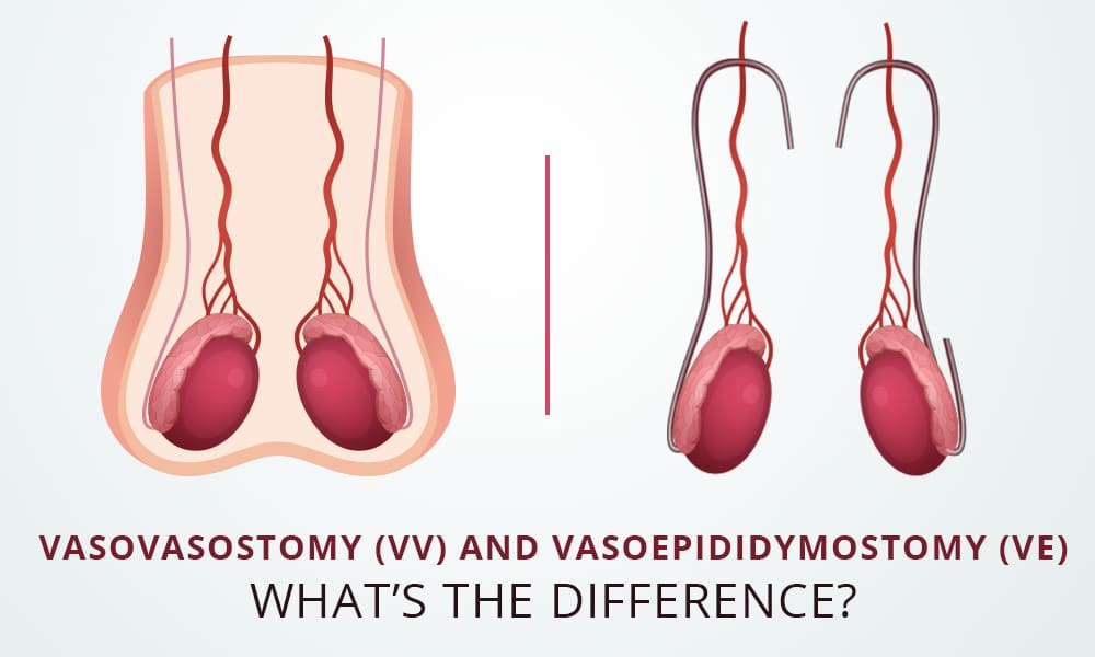 Vasovasostomy and Vasoepididymostomy
