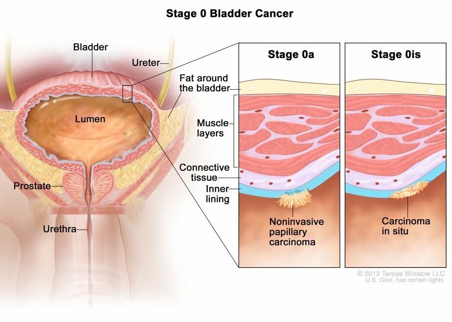 Stage 0 - Blabber Cancer