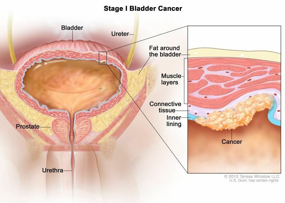 Stage 1 - Blabber Cancer