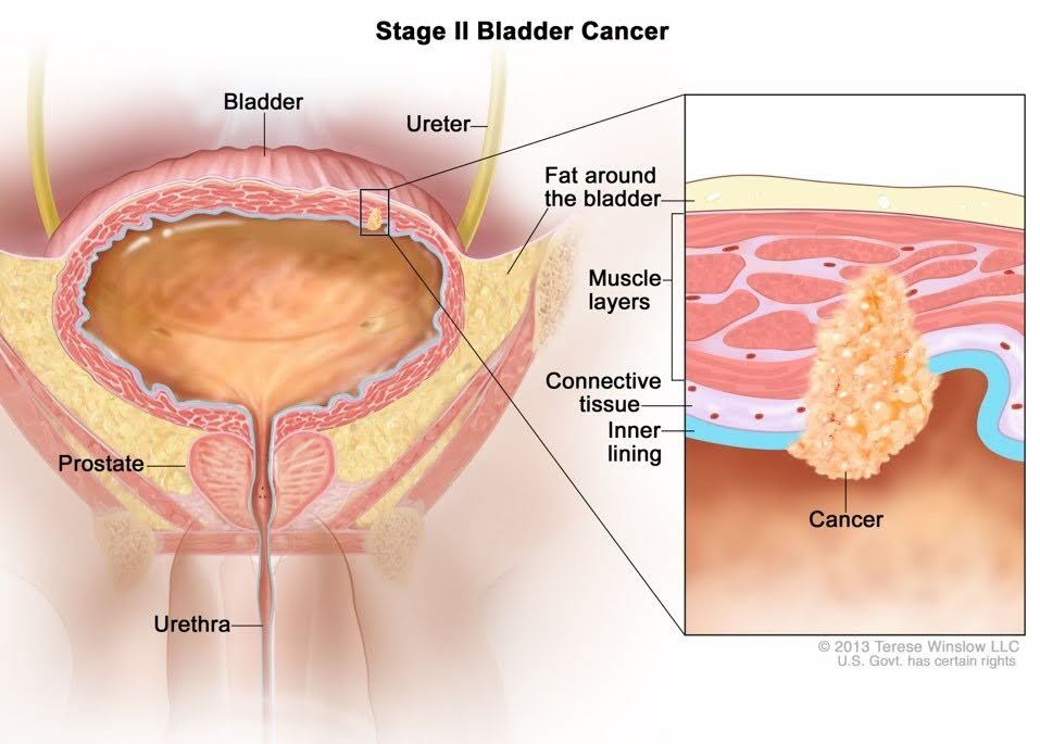 Stage 2 - Blabber Cancer