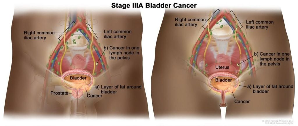 Stage 3A - Blabber Cancer