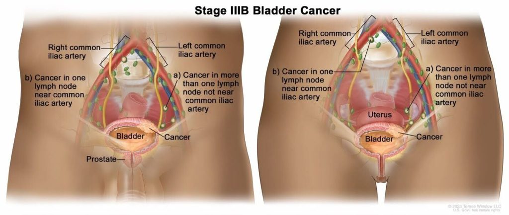 Stage 3B - Blabber Cancer