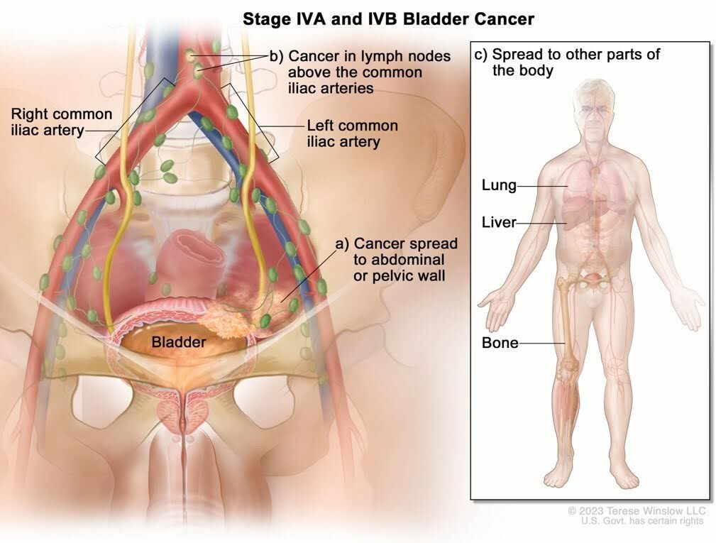Stage 4A and B - Blabber Cancer